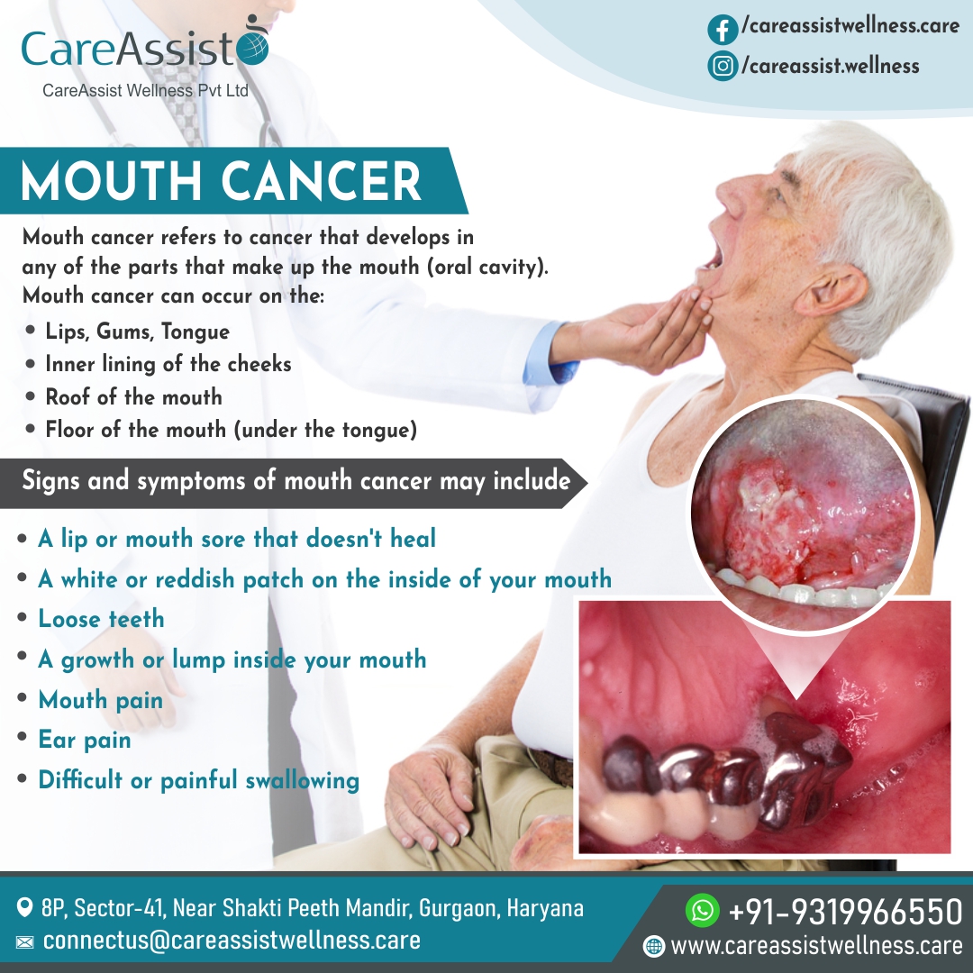 Mouth Cancer Causes Symptoms Best Healthcare Facilitator In India